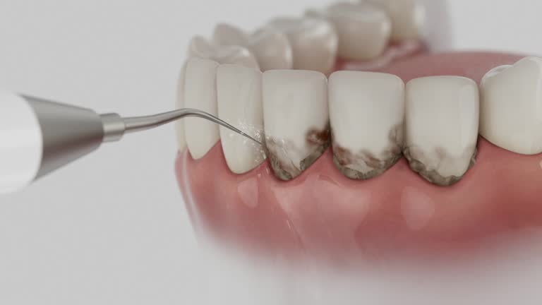 Reliable Tooth Extraction contractor in St. Louis County County, MO by Dentist Open Now